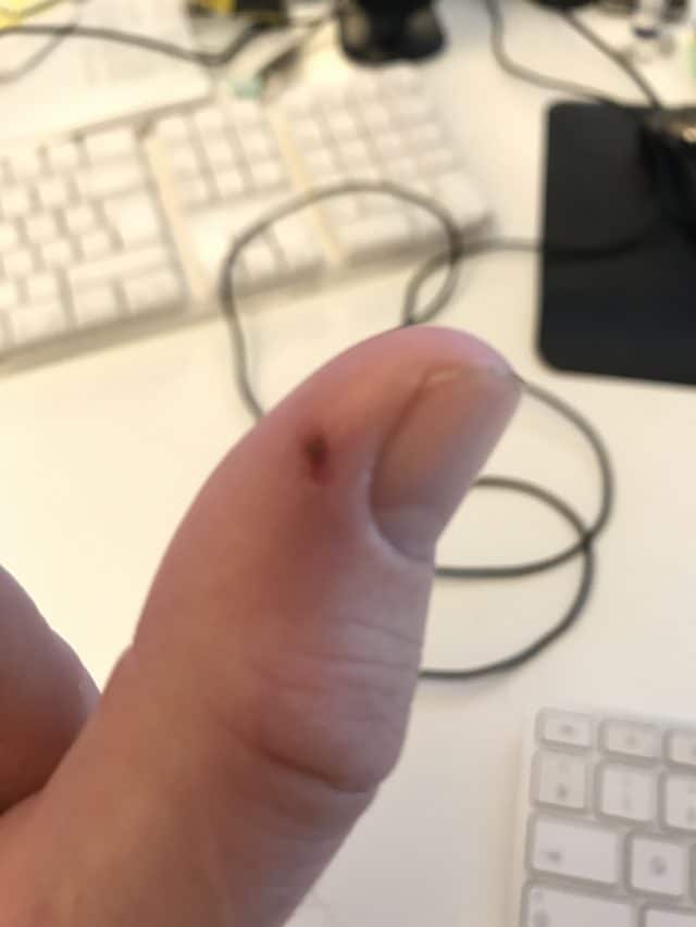 Injured Thumb With A Slight Cut